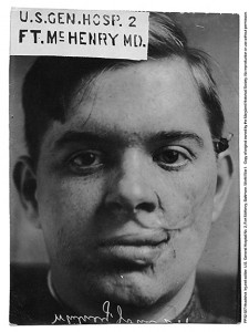 “Headshot. Injured Soldier," U.S. General Hospital No. 2, Fort McHenry, McFee Photograph Collection, PP32.927, MdHS.