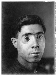 "Headshot. Injured Soldier, M. Giovanni,” U.S. General Hospital No. 2, Fort McHenry, McFee Photograph Collection,  PP32.932, MdHS.
